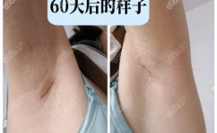 隆胸后可以用力抓吗